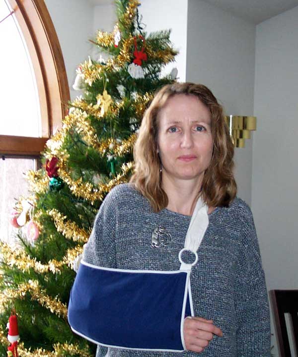 broken arm